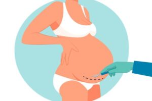 Caesarean Section (C-Section): What to Expect, Benefits, and Recovery