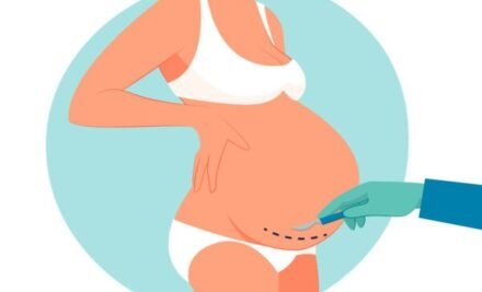Caesarean Section (C-Section): What to Expect, Benefits, and Recovery