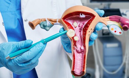 Advanced Fibroid Treatment by Dr. Arpana Jain in North Delhi