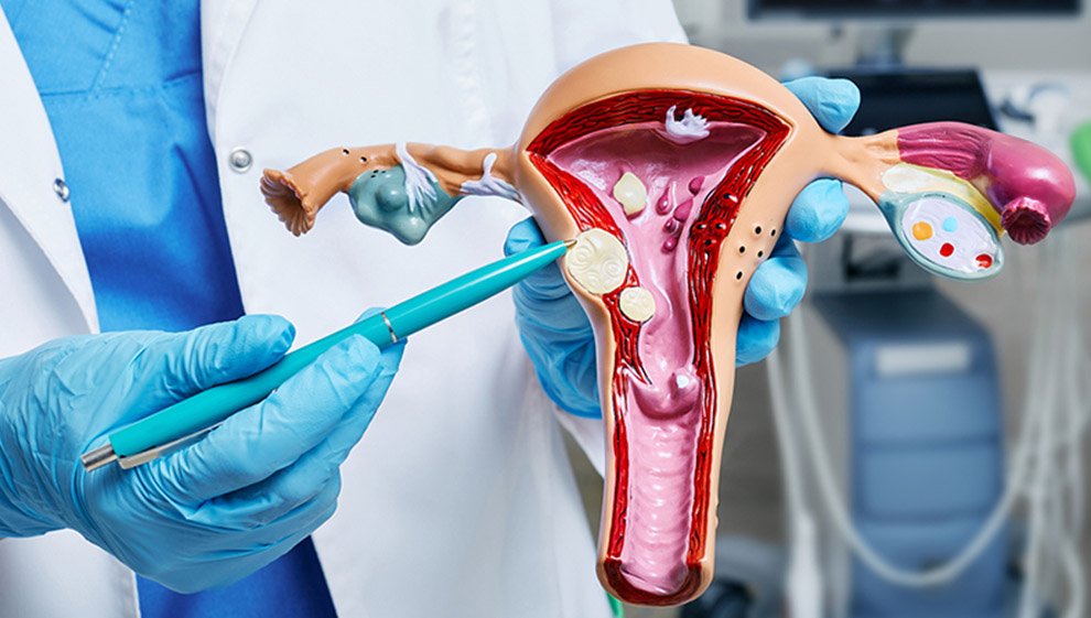Advanced Fibroid Treatment by Dr. Arpana Jain in North Delhi